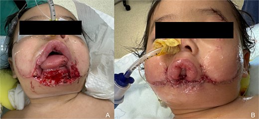 Initial presentation and local flap coverage. (a) Photograph upon initial presentation at 11 months of age to tertiary care facility demonstrating complete loss of lower lip with soft tissue defect exposing mandible. (b) Photograph following Karapandzic advancement flap coverage of mandible and resultant microstomia.