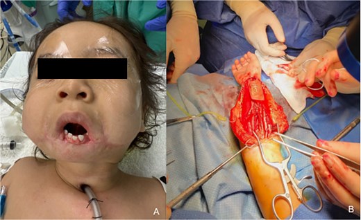 Preoperative evaluation and flap harvest. (a) Preoperative photograph (23 months of age) prior to definitive free flap reconstruction highlighting exposed mandibular dentition. (b) Intraoperative photo depicting harvest of the right RFFF.