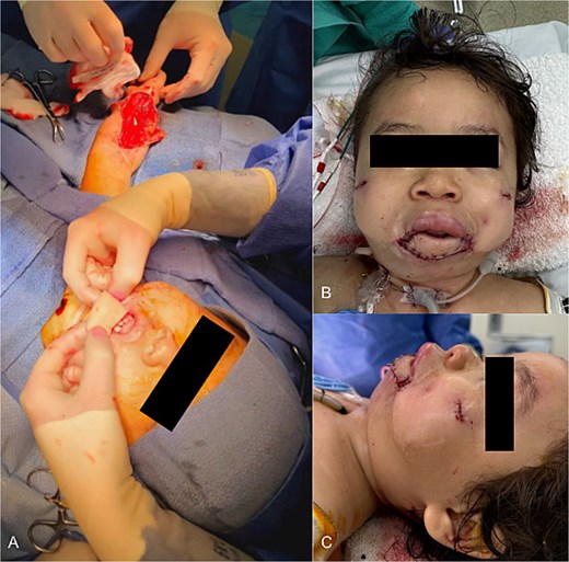 Inset of RFFF. (a) Intraoperative photo demonstrating the harvested RFFF positioned over the soft tissue defect. (b) Front profile following RFFF reconstruction of lower lip with suspension sutures to zygoma periosteum. (c) Side profile following RFFF reconstruction of lower lip.