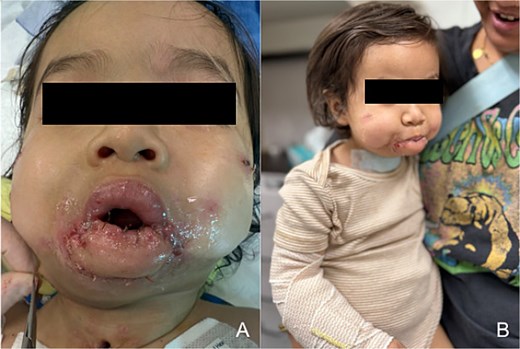 Postoperative outcome. (a) Postoperative photo demonstrating coverage of mandibular dentition following complex vestibuloplasty with split thickness skin graft and revision suspension of free flap to mandibular periosteum. (b) Patient photo from first postoperative check on POD 15 demonstrating mouth closure with lip opposition and restoration of oral competence.