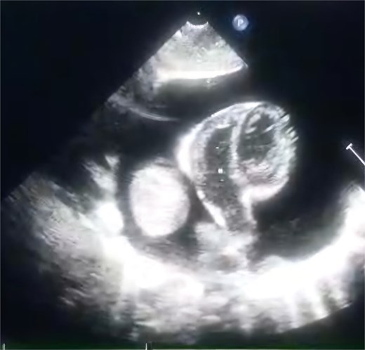 TTE view showing the massive pericardial effusion and the mass.