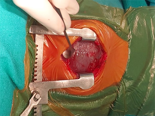 Intraoperative image showing the stretched pericardium due to massive effusion.