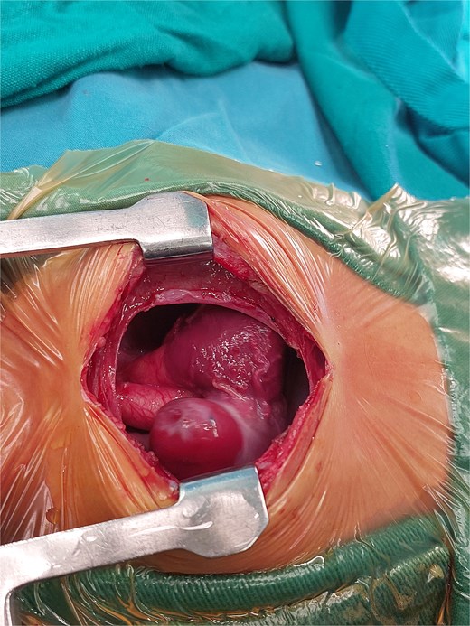 Intraoperative image showing the mass in the right atrium after opening the pericardium.