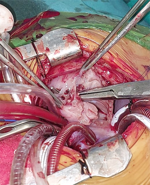 Intraoperative image showing the opened right atrium and the mass partially resected.