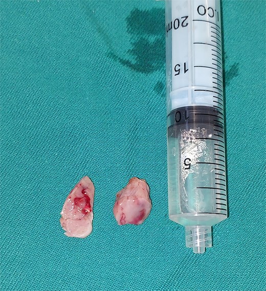 Intraoperative image showing the resected mass.