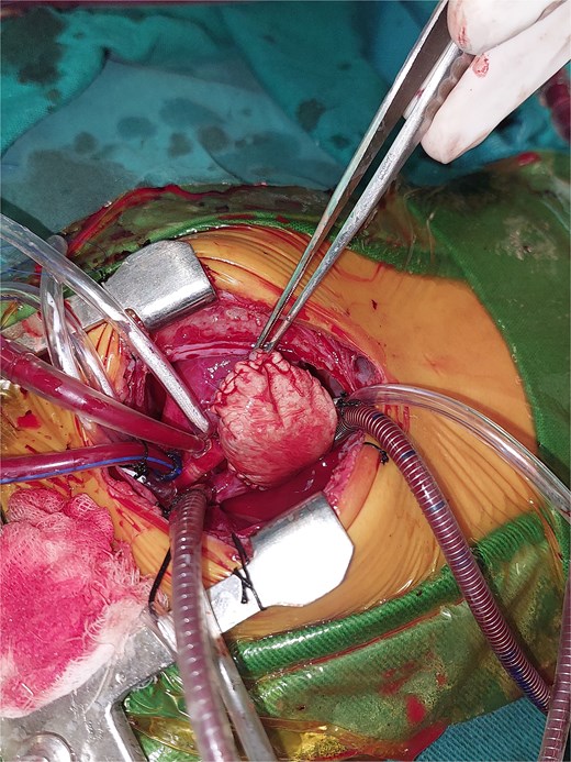 Intraoperative image showing the reconstructed right atrium with a bovine pericardial patch.