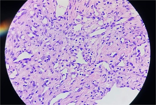 Histopathological image of the tumour.