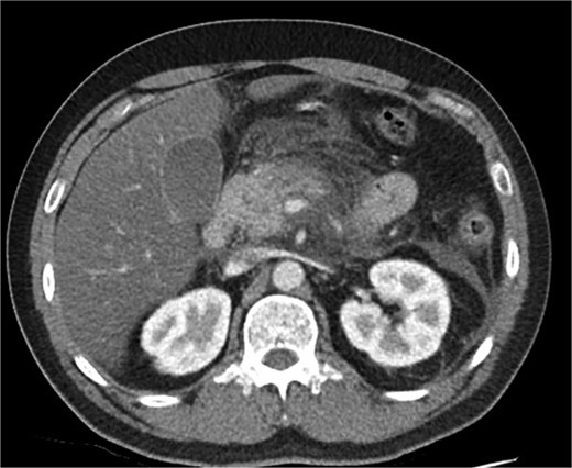 Axial CT image demonstrating body and tail pancreatitis with fat stranding.