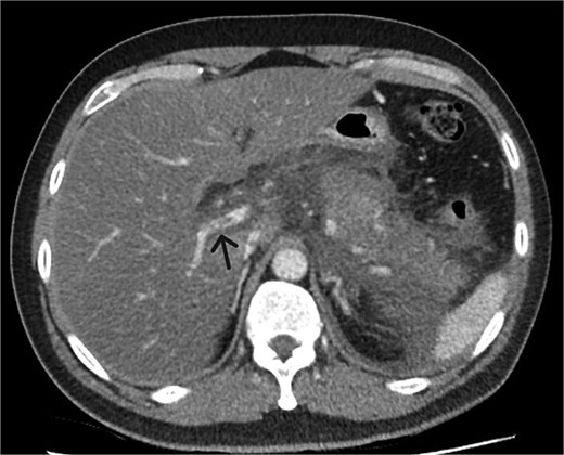 Axial CT image demonstrating non-occlusive portal vein thrombus (depicted by arrow).