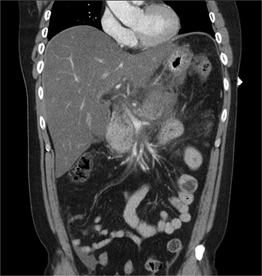 Coronal CT image demonstrating body and tail pancreatitis with potential early signs of necrosis.