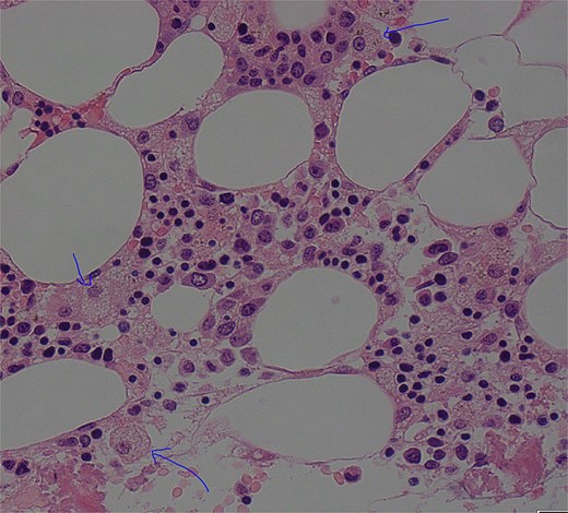 Low power view (100× magnification) of bone marrow aspirate smear with haematoxylin and eosin staining with multiple histiocytes demonstrated by blue arrows.