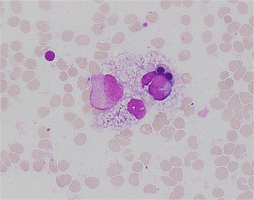 High power view (1000× magnification) of bone marrow aspirate smear with haematoxylin and eosin staining demonstrating haemophagocytosis by histiocyte (depicted in centre).