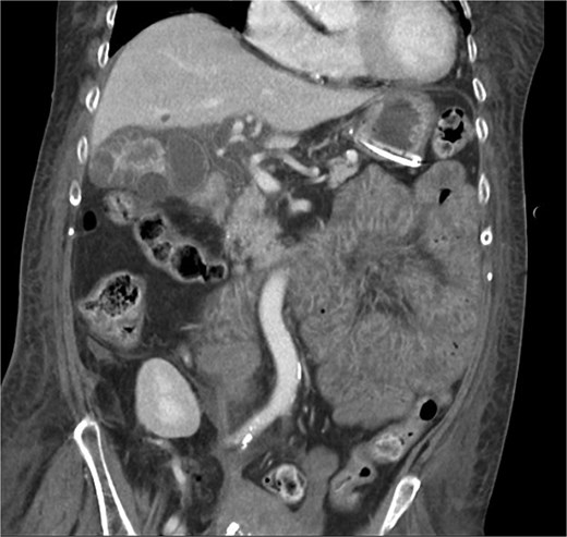 CT chest abdomen pelvis with IV contrast coronal view. The common bile duct is visible and without dilation, note multiple intramural hyperattenuating nodules and gallbladder wall hyperenhancement. This image also shows diffusely edematous jejunum indicative of systemic hypoperfusion.