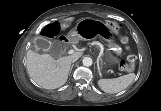 CT chest abdomen pelvis with IV contrast axial view. Gallbladder wall hyperenhancement and multiple intramural hyperattenuating nodes are again apparent in axial imaging.