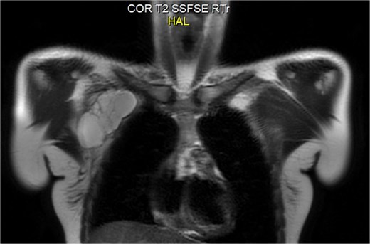 MRI showing a large cystic mass.