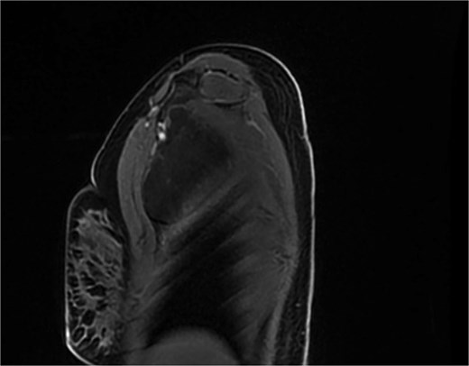 Lesion compressing neurovascular bundle (arrow).