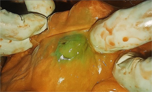 Intra-operative ICG fluorescence of the caecum (distal most aspect of colonic conduit) indicating satisfactory perfusion.