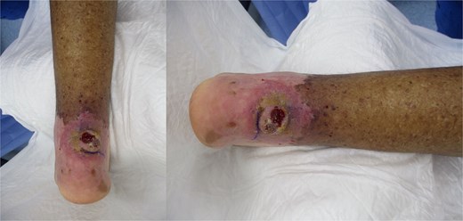Chronic non-healing retrocalcaneal ulcer at the initial presentation.