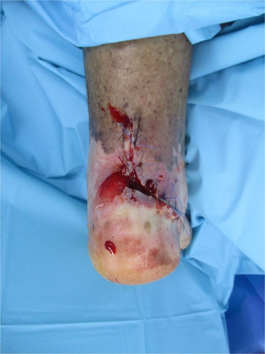 Intraoperative view showing wide local excision of the retrocalcaneal ulcer; histology confirmed well-differentiated SCC (pT2Nx) with 8 mm invasion depth; defect prepared for regional advancement flap coverage.