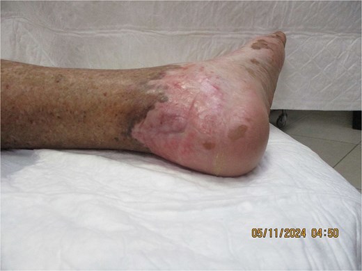 Completely healed retrocalcaneal region at 4 months post-surgery and adjuvant radiotherapy following regional advancement flap reconstruction, demonstrating durable coverage and limb preservation.