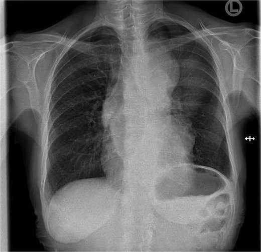 Chest X-ray at first presentation showing an enlarged mediastinum.
