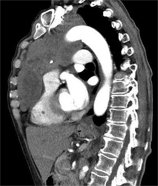 Chest CT in sagittal view showing a large tumor mass in the anterior mediastinum.