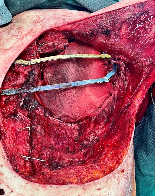 Intraoperative view of the chest wall reconstruction.