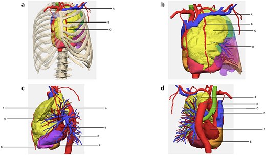 3D-reconstruction. (a) Anterior view with rib cage. A = vena subclavia; B = arteria mammaria interna; C = tumor. (b) Anterior view without rib cage. A = vena subclavia; B = arteria mammaria interna; C = tumor; D = lung. (c) Lateral view without lung. A = aorta; B = left atrium; C = left ventricle; D = right ventricle; E = right atrium; F = tumor; G = left arteria mammaria interna. (d) Posterior view with focus on aorta. A = tumor; B = aorta; C = trachea; D = vena cava superior; E = right atrium; F = left atrium.