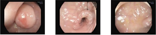 Sigmoidoscopy showing a non-pedunculated subepithelial lesion measuring ≈2.0 cm located 23 cm from the anal verge; the overlying mucosa is intact, the pillow sign is negative, and the lesion does not appear yellowish. The descending colon is normal.