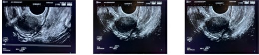 Endoscopic ultrasound demonstrating a homogeneously hypoechoic, smooth-margined lesion arising from the muscularis layer. Endoscopic tattooing for surgical localization, lesion marked at 23 cm from the anal verge with three tattoo spots placed 3 cm distal to the lesion.