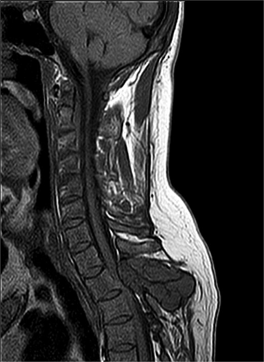 MRI thoracic spine: Extradural lobulated minimally enhancing lesions involving spinous process of T2 vertebra, right pedicle and lamina of T3 vertebra and posterior aspect of left T2 rib.