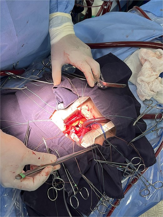Mini-sternotomy.