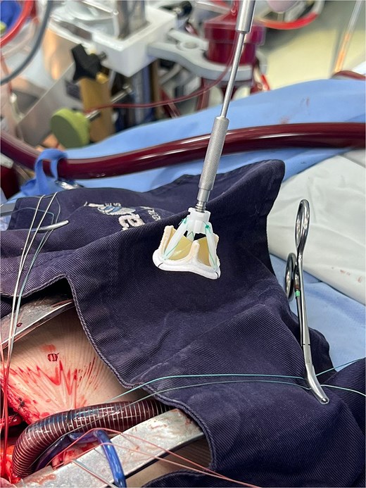 Bioprostheses Inspiris Resilia®.