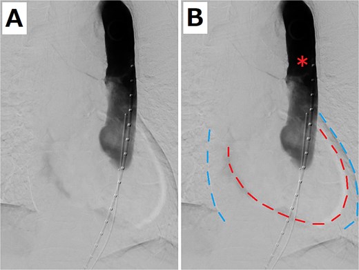 (A) Aortography when the patient had pulseless electrical activity. (B) Pericardial effusion is shown. The red and blue dashed lines indicate the edge of the heart and pericardium, respectively. The red asterisk shows that the flow was stagnating in the stent graft.