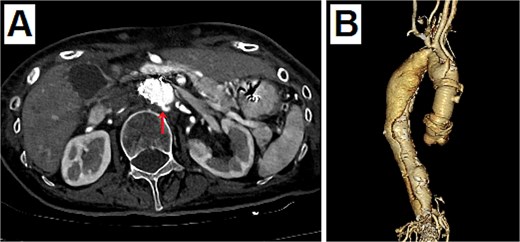 Postoperative enhanced CT. (A) The entry of dissection existed at the top of the stent at the abdominal aorta (arrow). (B) The 3D CT viewed from the right side. The dissection was connected to the distal side of the ascending aortic artificial graft from the top of the stent at the abdominal aorta.