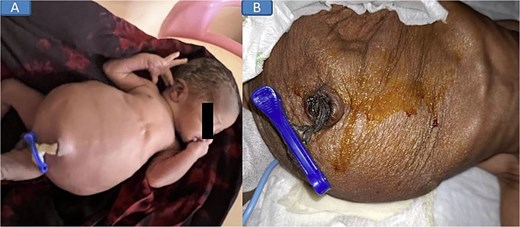 Pre-nephrostomy drainage abdominal distention (A) and post-nephrostomy (B).