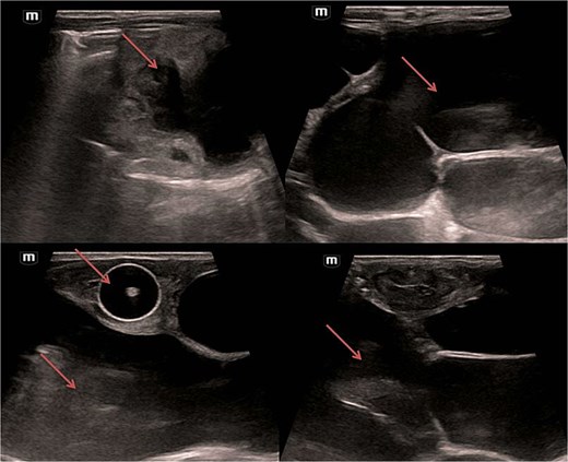 Bilateral multilocular cystic hydronephrosis.