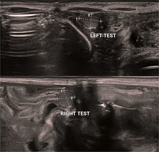 Bilateral cryptorchidism.