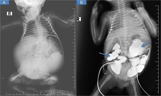 Pre-op abdominal X-ray (A) and post-operative percutaneous nephrostomy procedure with contrast injection through the nephrostomy (B).
