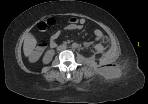 Patient A. Initial CT abdomen and pelvis showing left subcutaneous fluid collection extending intra-abdominally.