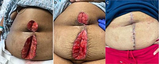 Patient A. a. Incision at first wound vac change after initial operation (POD 3). b. Incision prior to DPC (POD 13). c. Incision at first post op visit (15 days after DPC).