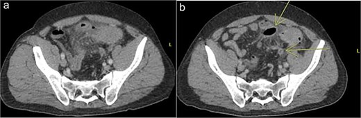 Patient B. a. Initial CT abdomen and pelvis showing acute diverticulitis with small adjacent abscess. b. Repeat CT abdomen and pelvis with worsening complicated diverticulitis.