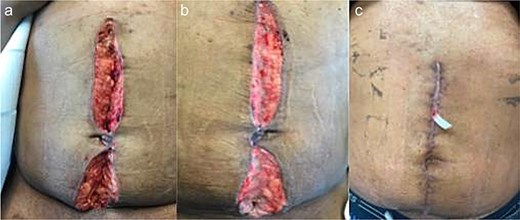 Patient B. a. Incision at first wound vac change after initial operation (POD 2). b. Incision prior to DPC (POD 8). c. Incision at first post op visit (27 days after DPC).