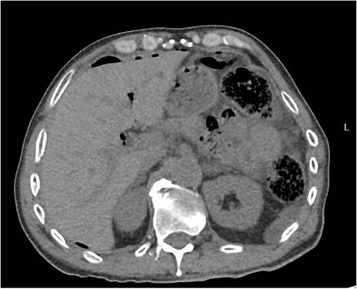Patient C. Initial CT abdomen and pelvis showing free air concerning for perforated hollow viscus.