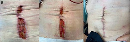 Patient C. a. Incision at first wound vac change after initial operation (POD 4). b. Incision prior to DPC (POD 11). c. Incision at first post op visit (10 days after DPC).