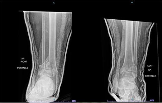 Anterior-to-posterior (AP) radiographs of patient 1 obtained 10 days after injury, upon transfer to our facility, demonstrating bilateral pilon fractures.