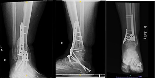 Radiographs of patient 1 obtained 3 years after the index procedure, including AP view of the left ankle and lateral and oblique views of the right ankle following subtalar fusion.