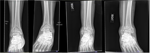 AP and oblique radiographs of patient 2 obtained after a fall, demonstrating bilateral pilon fractures and retained hardware from prior bilateral calcaneal ORIF.