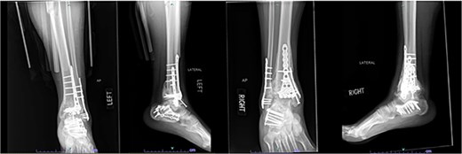 Two-year follow-up AP and lateral radiographs of both ankles in patient 2 showing maintained alignment and hardware position.