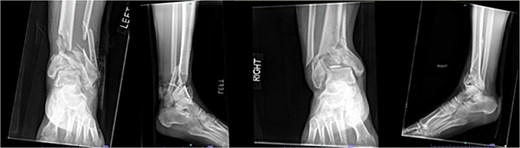 Initial AP and lateral radiographs in patient 3 demonstrating bilateral open pilon fractures with severe comminution of the left ankle.
